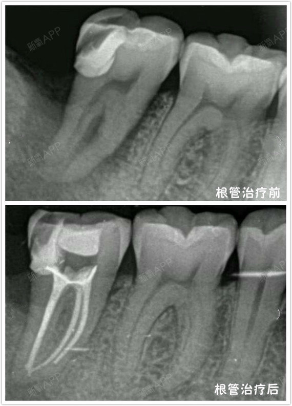 牙齿缺一块补牙多少钱?伤到牙髓补牙还有用吗?07