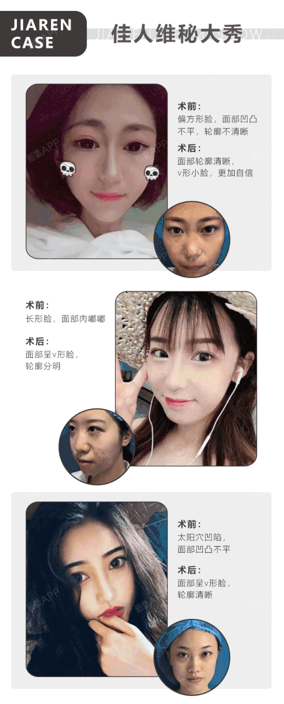 【菲洛嘉】(组合套餐)菲洛嘉3ml美白嫩肤 祛黑眼圈 机