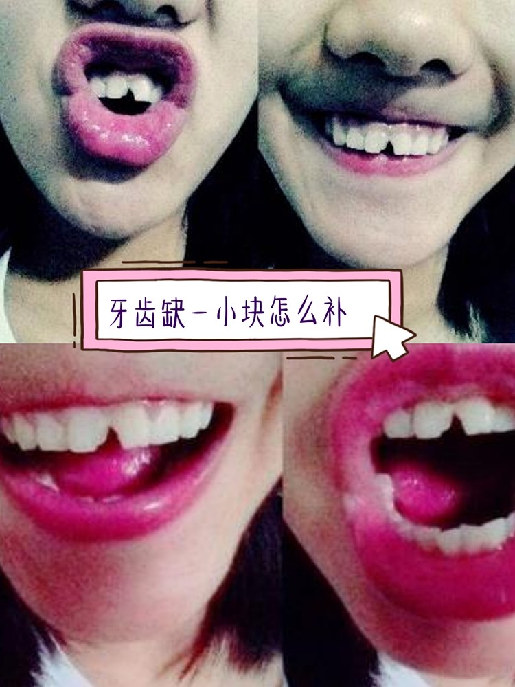 牙齿缺一块补牙多少钱?