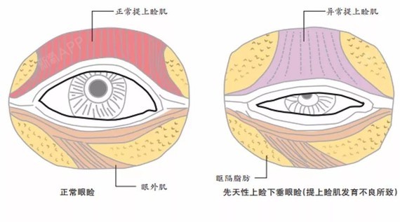 上睑提肌