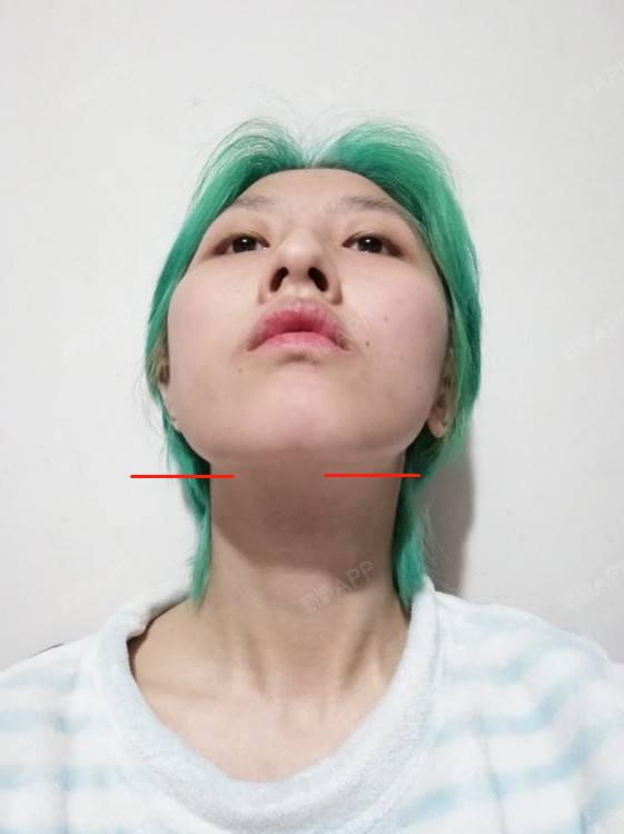 这张仰面,可以看到面部线条不流畅的问题,还有大小脸,很明显的骨骼
