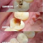简单来说,牙齿龋坏未导致牙髓炎的顾客,可一次补牙
