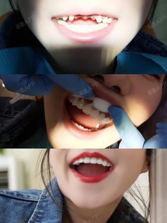 口内假牙应该如何护理?