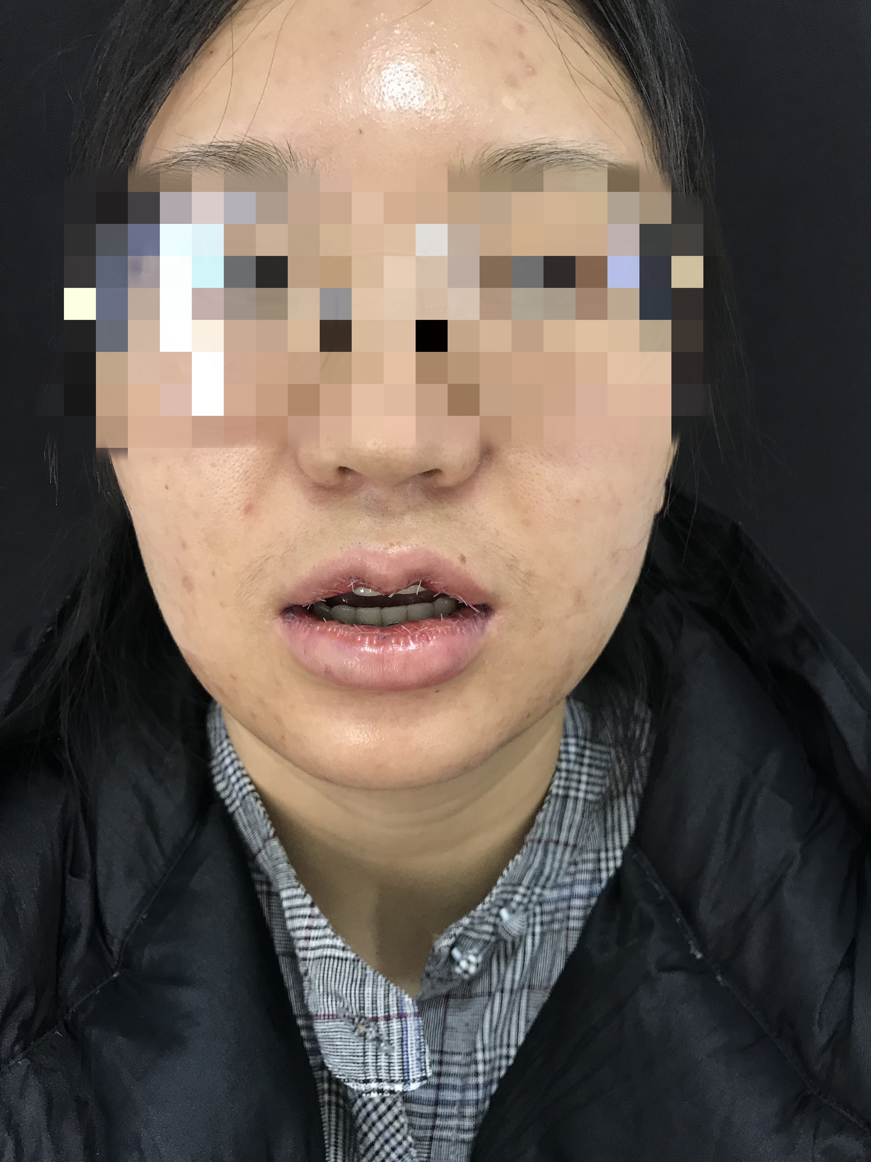 m唇手术第1天