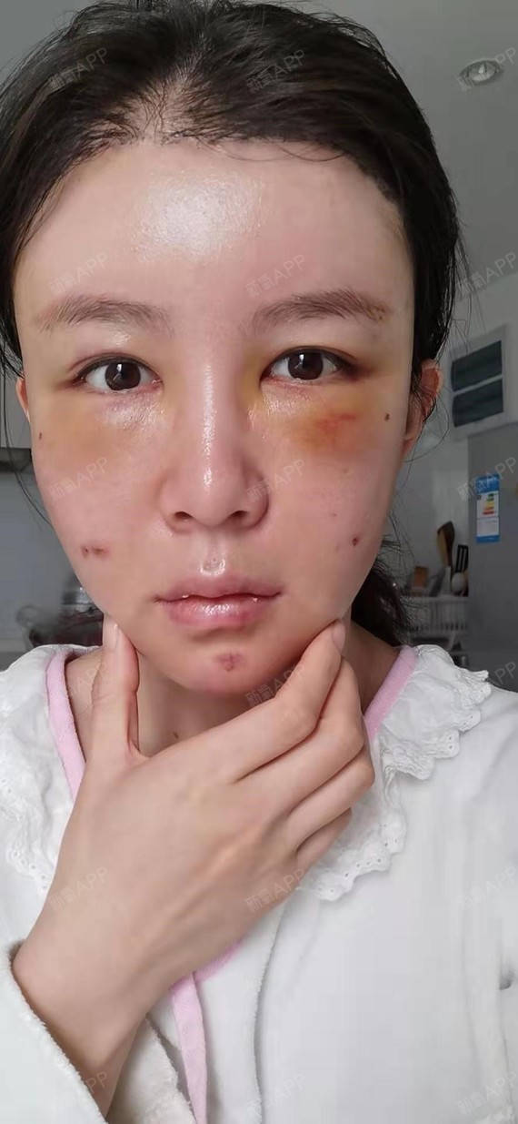 第三天淤青开始消退,变黄,但是整个脸部还是廷肿的,华为手机真的是离