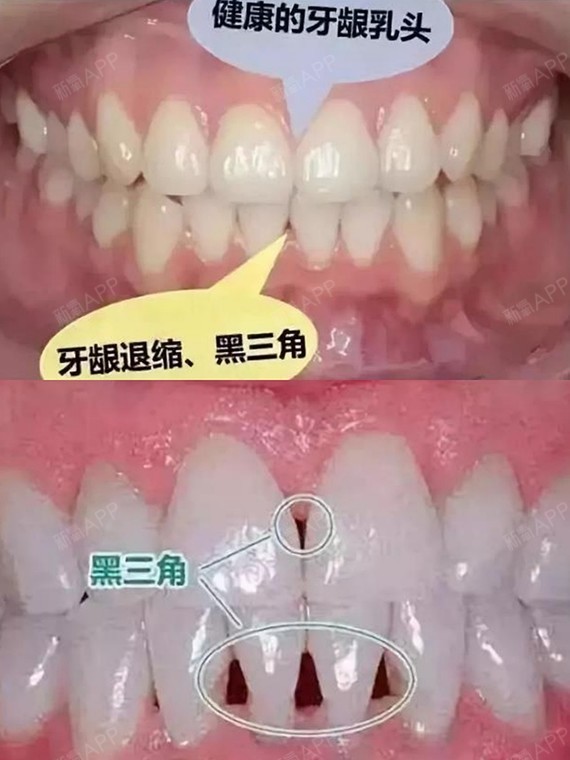 戴牙套后牙龈萎缩出现黑缝怎么回事?