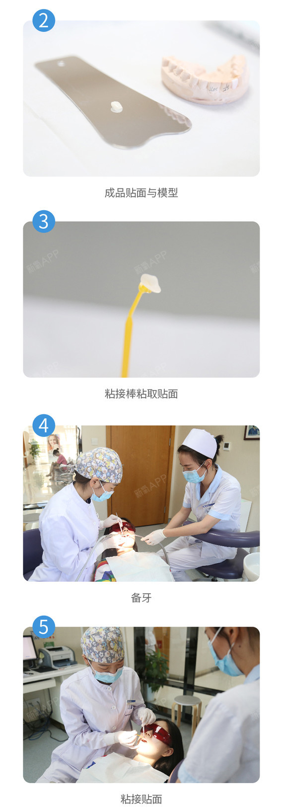 【瓷贴面】牙齿美白贴面,美白牙齿,色素牙,牙稀疏,牙缺损,不伤牙龈