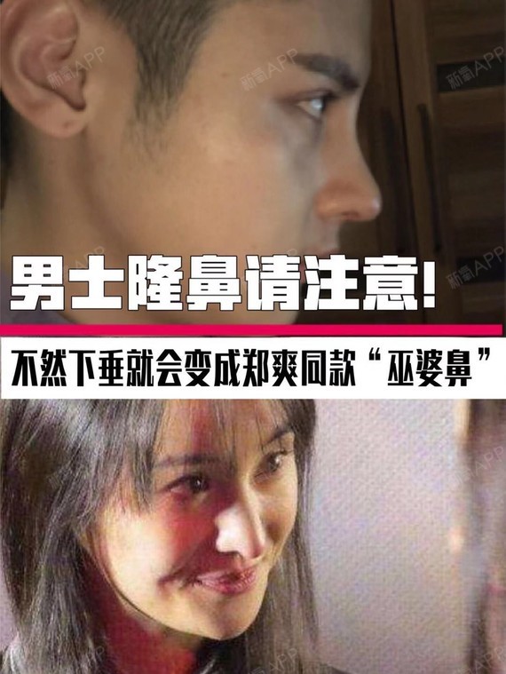 男生隆鼻后也有可能下垂,变成郑爽的巫婆鼻"因为男女性的鼻子外观区别