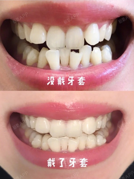 干掉【丑牙】系列之浅谈牙齿矫正的基本流程!