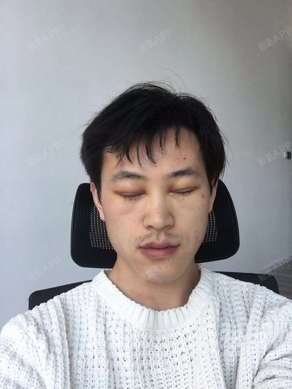 上眼睑去脂好不好_效果图_氧气zscss上眼睑去脂术后第3天_新氧美容