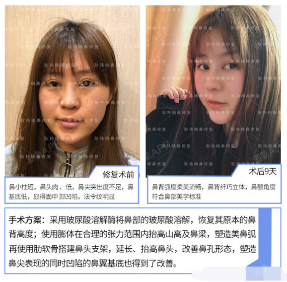 鼻部整体塑料感就会偏强,面部会给人一种看起来粗狂而不够女性化的
