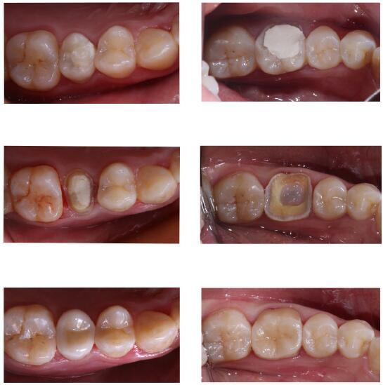 深圳世纪河山口腔真人案例#蛀牙嵌体修复