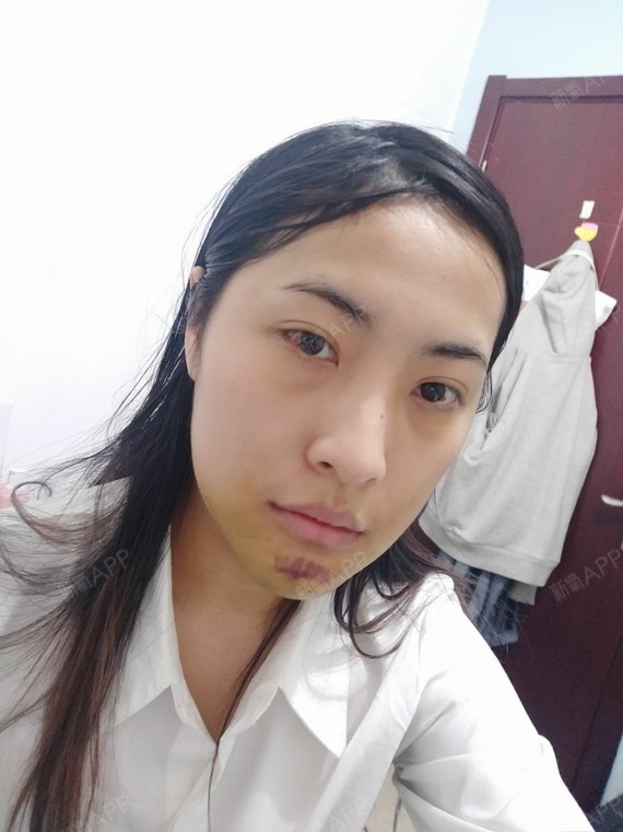 假体丰下巴