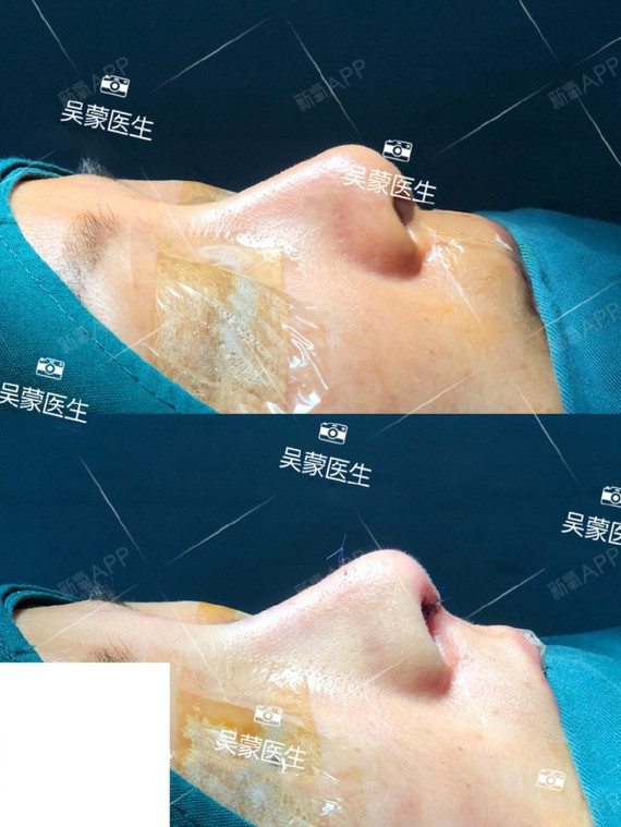 顾客硅胶隆鼻十年之后,鼻头挛缩,鼻翼缘不佳,进行了_圈子-新氧美容