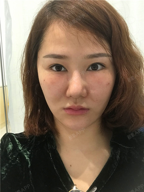 北京知音医疗美容李奇军 苹果肌生长因子取_圈子-新氧