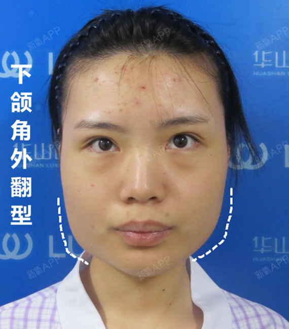 这位是典型的外翻型下颌角,面部看上去呈梯让形轮廓缺乏柔和的