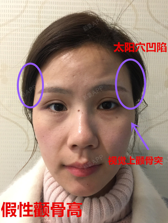 先别着急磨骨很多人看到自己眼眶下高