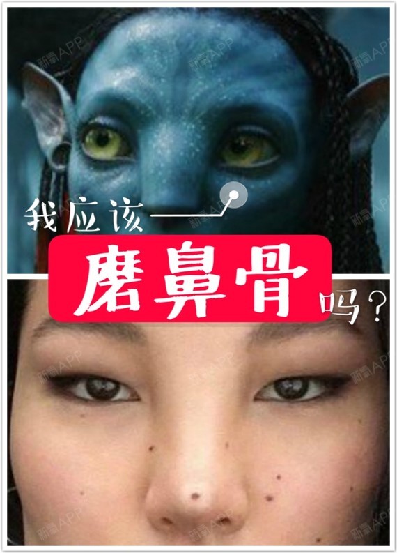 92很多姑娘鼻背宽大,于是认为应该做磨骨,把鼻_圈子-新氧美容整形