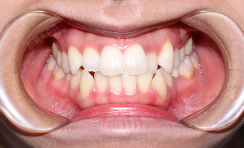牙齿变黄这个现象并不只存在于牙齿矫正期间,任何时段都有可能发生.