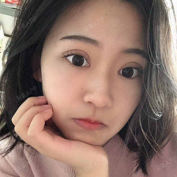 【贵阳美贝尔—眼部多项】20多天了,眼睛没有之前_圈子-新氧美容