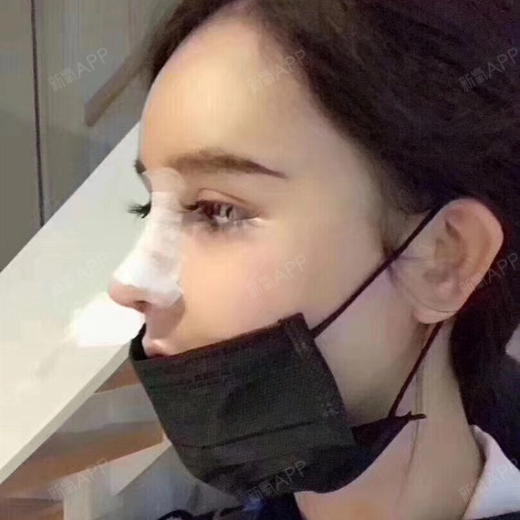 硅胶假体隆鼻透光是因为