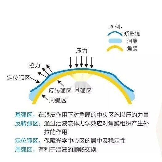 佩戴三年ok镜(角膜塑形镜)体验分享及缴绍