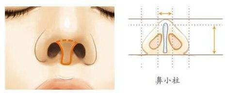 下面我介绍几种鼻小柱问题的解决方法:1,鼻小柱下垂通过鼻中隔前段