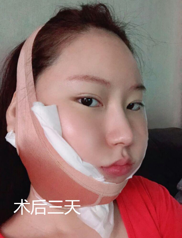 一分钟带你了解无痕mini小切口拉皮和线雕的区别