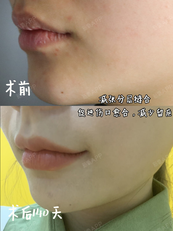 微笑唇,嘴角上扬手术or注射肉毒素?手术更靠谱,花