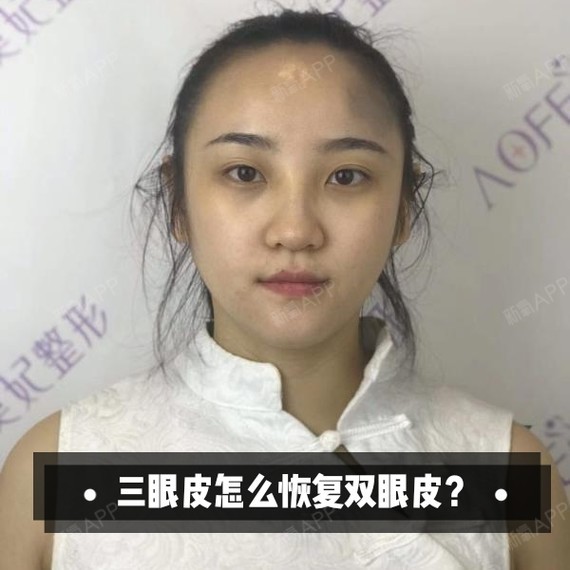 什么是三眼皮?