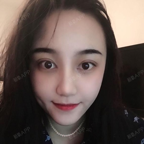 什么是三眼皮?