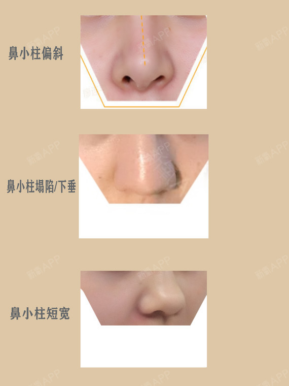 鼻小柱这5种常见的缺陷,严重影响鼻部美观!