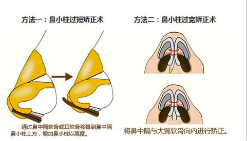 鼻小柱这5种常见的缺陷,严重影响鼻部美观!