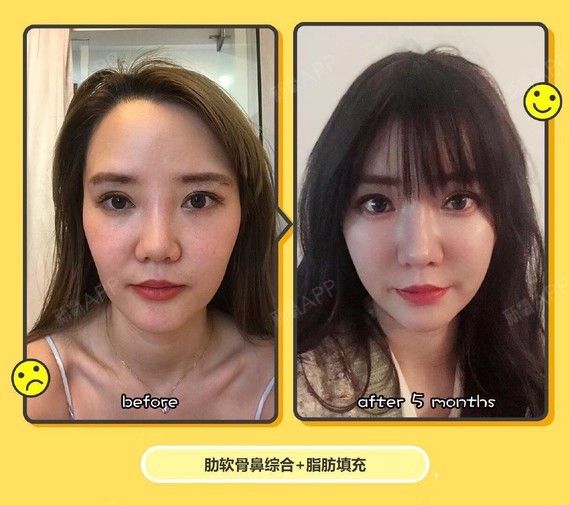 线雕隆鼻到底值不值得做呢?