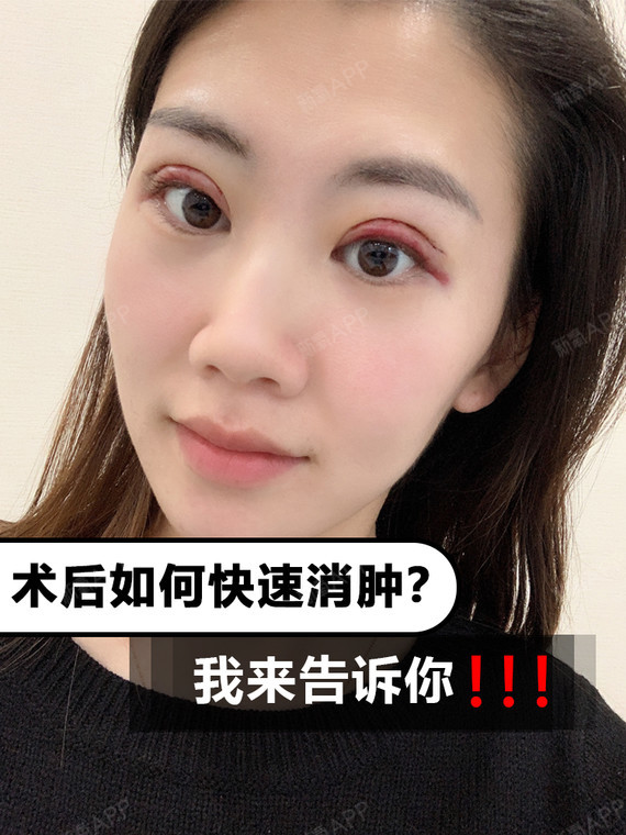 双眼皮术后眼睛肿胀,如何快速消肿?