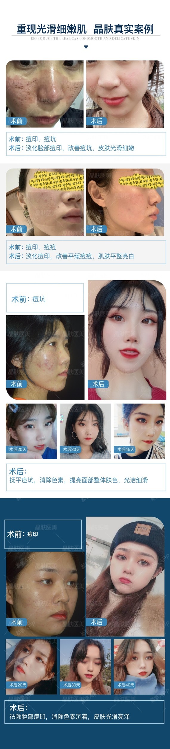 【点阵激光】二氧化碳点阵激光 祛痘坑痘印美白嫩肤改善毛孔粗大