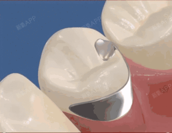 种植牙那些你不知道的事