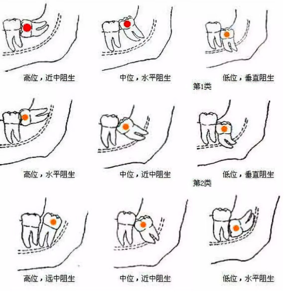 智齿到底要不要拔?