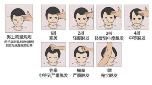 你的发际线高吗?自测一下吧!