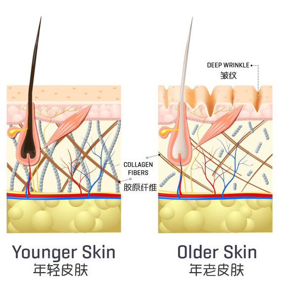 而像痘坑,凹陷型疤痕,这些都是因为皮肤真皮层胶原和弹性纤维