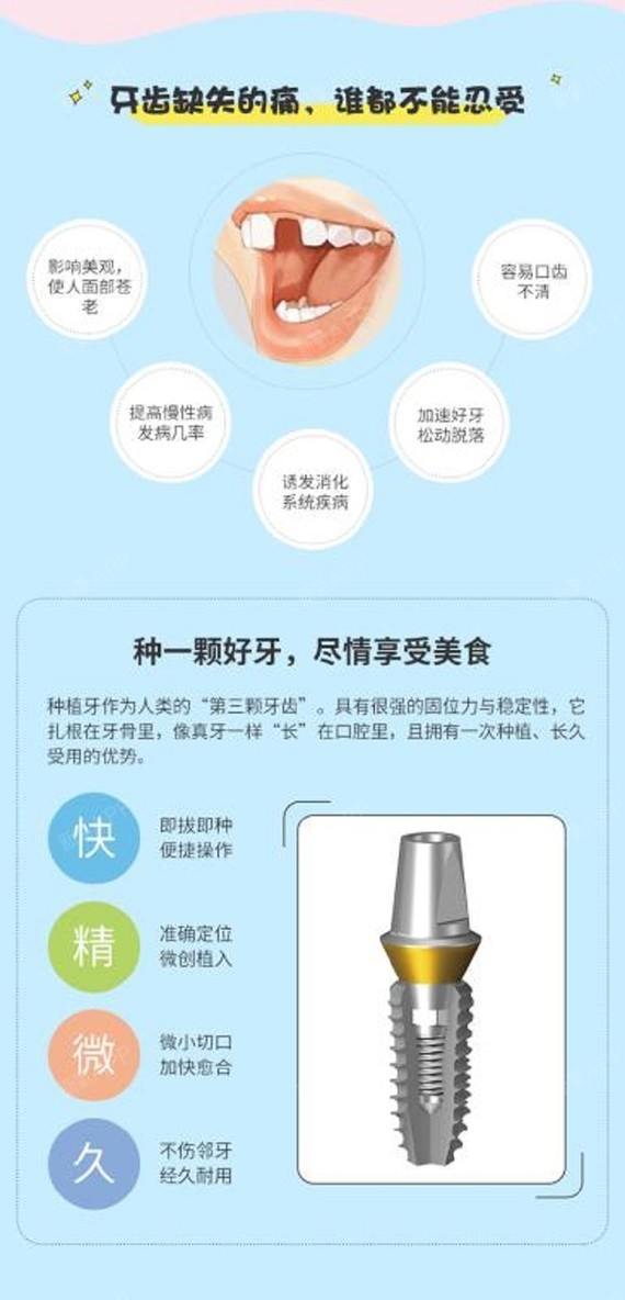 【种植牙】韩国进口种植牙 基台 烤瓷冠修复牙齿缺失缺损坚固耐用