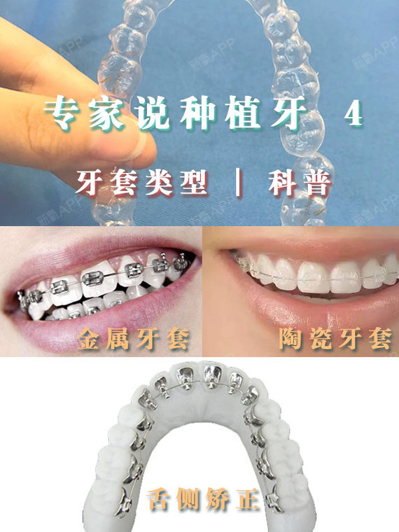 专家说种植牙【5】牙套类型|科普99确定做牙齿矫正