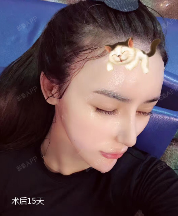 假体隆鼻后,如果对鼻部形态满意,且没出现什么异常或不适症状,就无需