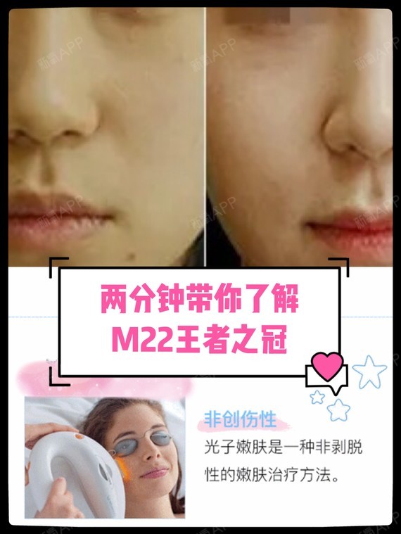 两分钟带你了解m22王者之冠m22王者之冠是什么?_圈子