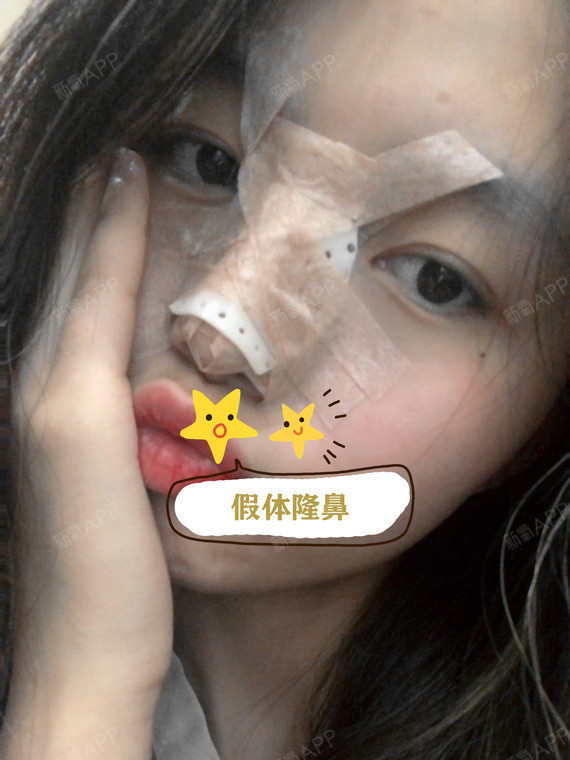 面部各项整形手术后包扎你知道多少