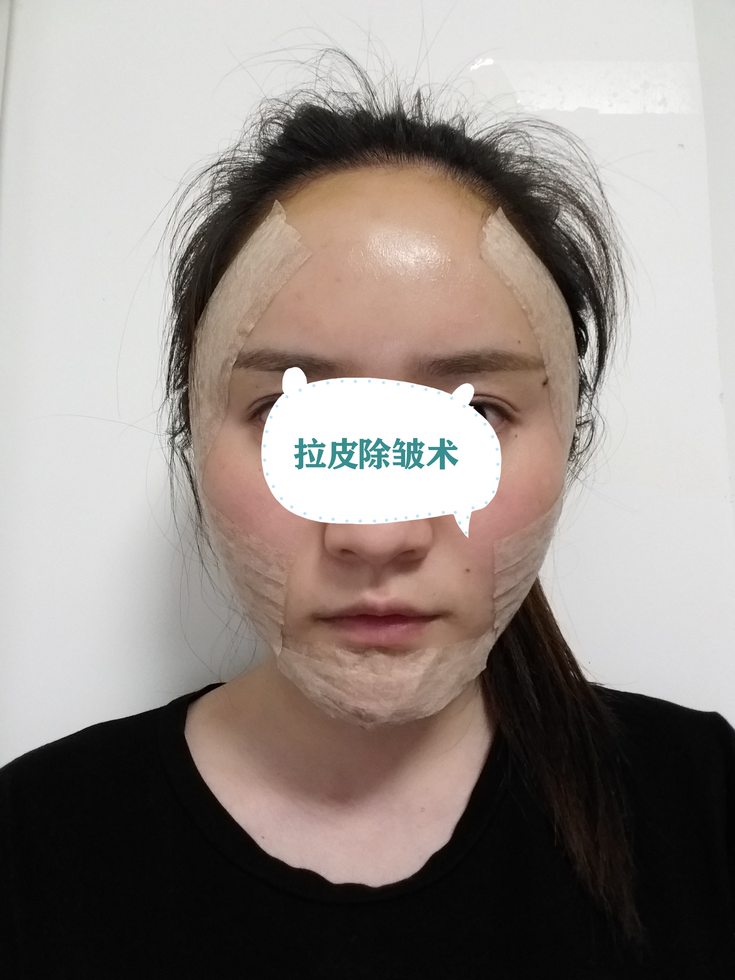 面部各项整形手术后包扎你知道多少