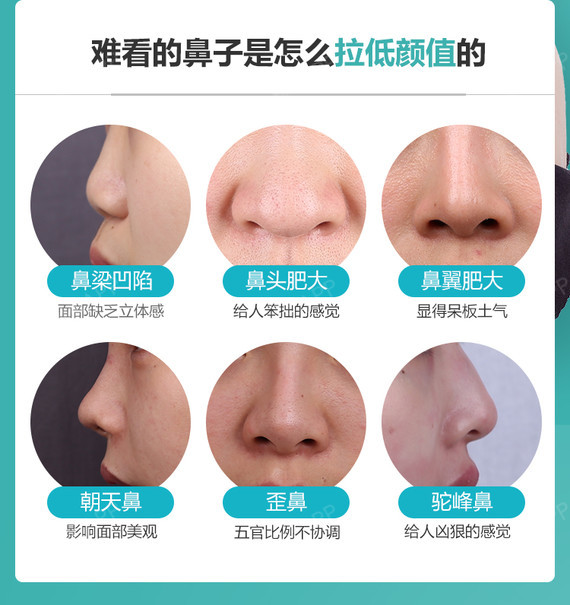 【手术缩鼻头】上海华美鼻头缩小 改善圆鼻头,肉鼻头