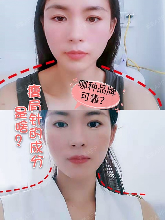 瘦肩针的成分是啥?哪种品牌可靠?