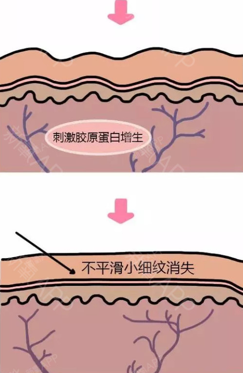 光子嫩肤!为什么别人做了比你效果好?