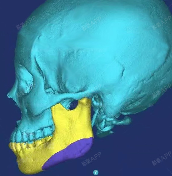 右侧截骨后的下颌角骨骼
